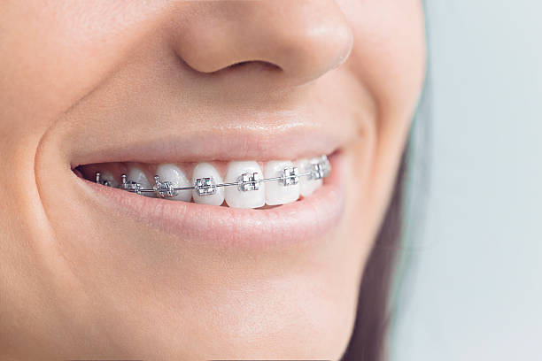 Best Traditional Braces  in Clover, SC
